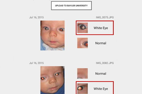 Esta aplicación gratuita es capaz de detectar un rarísimo cáncer ocular un año antes que los propios médicos Esta aplicación gratuita es capaz de detectar un rarísimo cáncer ocular un año antes que los propios médicos