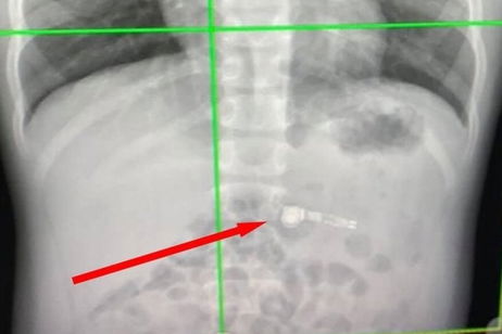 Esta es la historia del niño de 7 años que se comió un AirPod Esta es la historia del niño de 7 años que se comió un AirPod