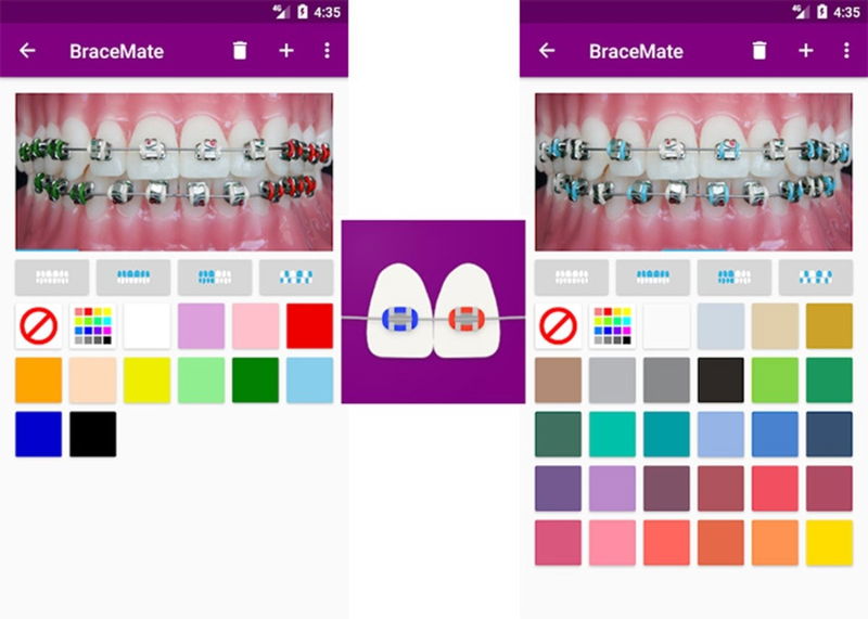 Las mejores 8 apps simuladores de brackets así te quedarían los aparatos