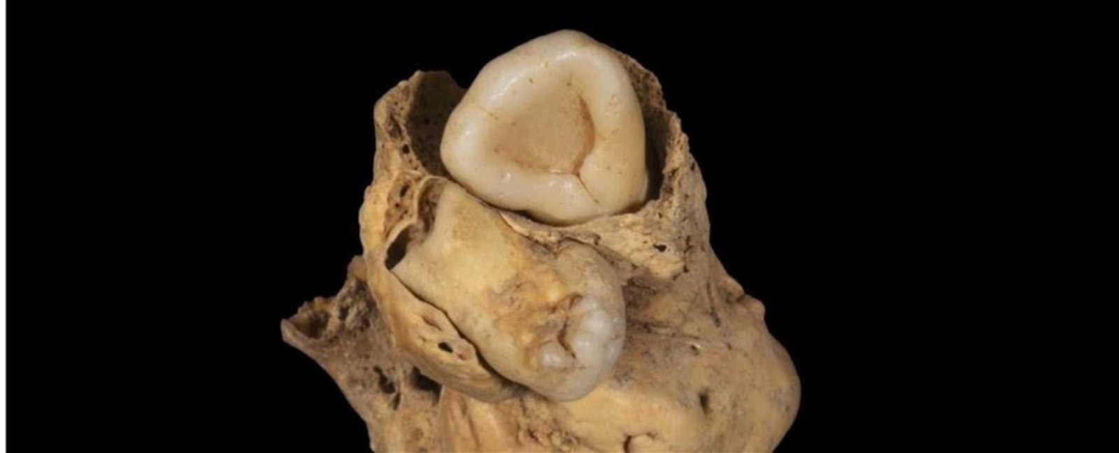 Hace 3000 años esta mujer egipcia vivió con un tumor de dientes en la cadera
