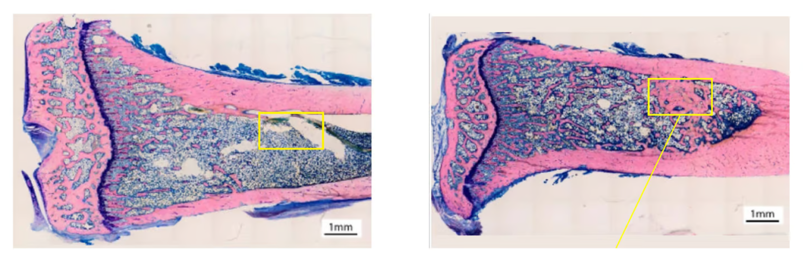 Gel óseo contra la osteoporosis