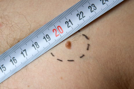 Desarrollan un modelo de inteligencia artificial que previene la metástasis de uno de los cánceres más comunes